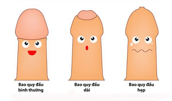 Hẹp bao quy đầu – bệnh lý không nên chủ quan - Ảnh 1.