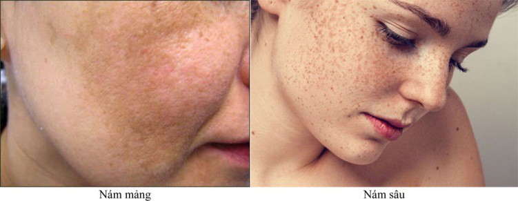 Tại sao da bị nám và cách điều trị - Ảnh 1. Tại sao da bị nám và cách điều trị - Ảnh 1.