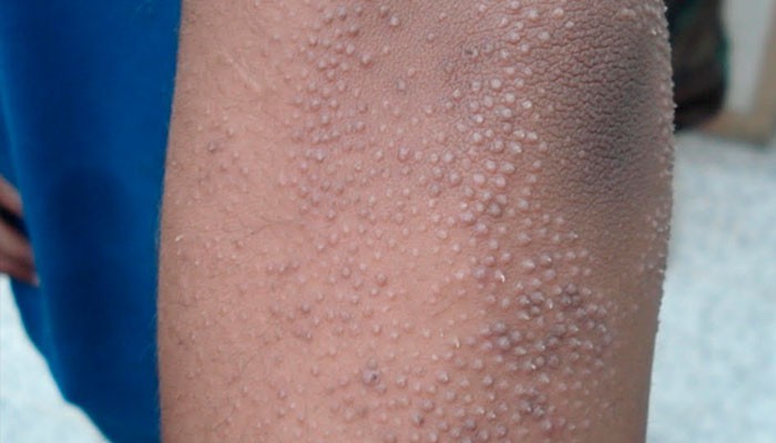 Bệnh dày sừng nang lông - Ảnh 1. Bệnh dày sừng nang lông - Ảnh 1.