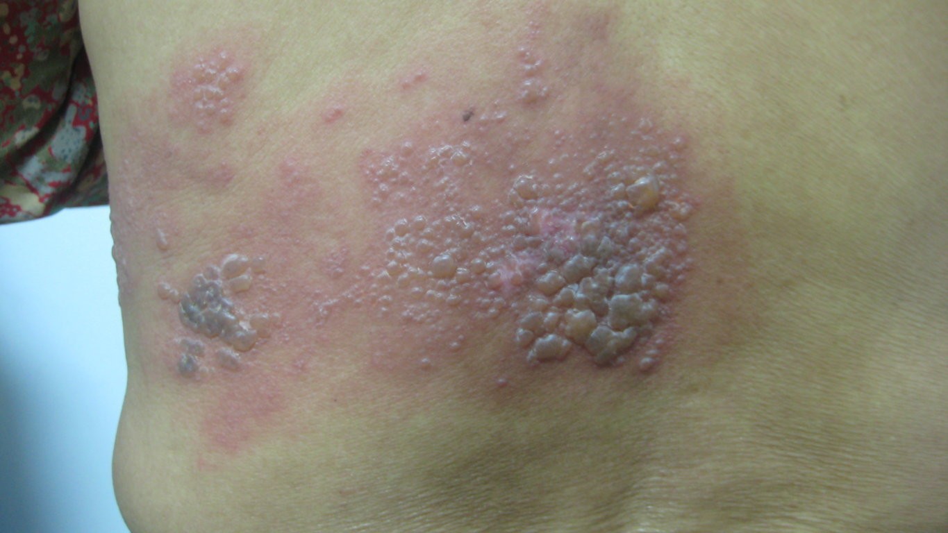 Đề phòng các biến chứng từ bệnh zona thần kinh - Ảnh 1.