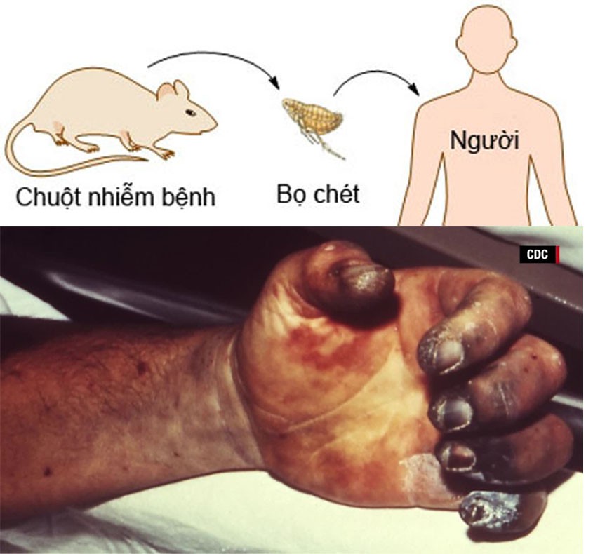 Bệnh dịch hạch và những điều cần biết - Ảnh 1. Bệnh dịch hạch và những điều cần biết - Ảnh 1.