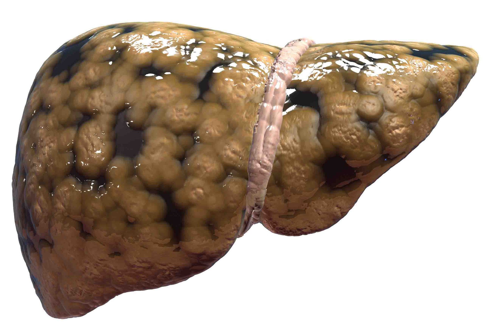 Dinh dưỡng trong bệnh gan nhiễm mỡ - Ảnh 1. Dinh dưỡng trong bệnh gan nhiễm mỡ - Ảnh 1.