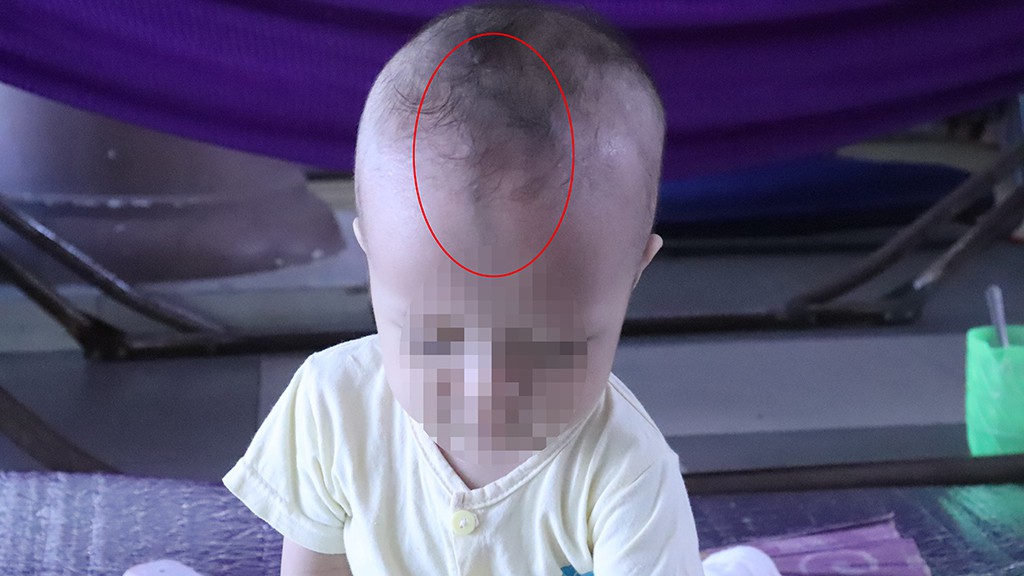 Đường gờ dọc trán trẻ có nguy hiểm? - Ảnh 1. Đường gờ dọc trán trẻ có nguy hiểm? - Ảnh 1.
