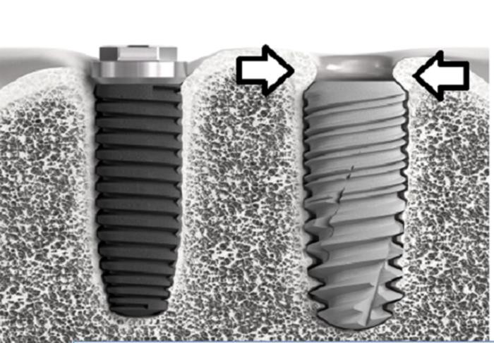 Ưu điểm răng Implant ETK Active của Nha Khoa Đông Nam - Ảnh 3.