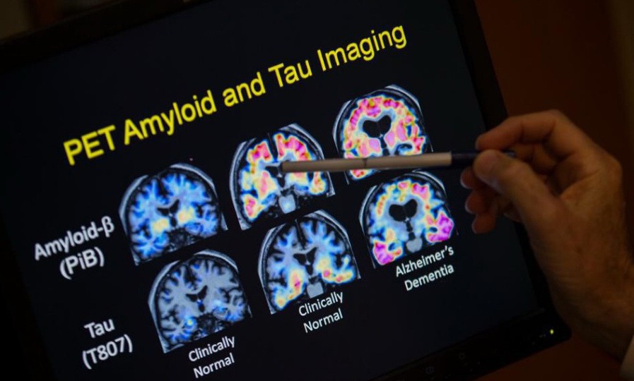 Có thể trị bệnh Alzheimer mà không cần đến thuốc - Ảnh 1. Có thể trị bệnh Alzheimer mà không cần đến thuốc - Ảnh 1.