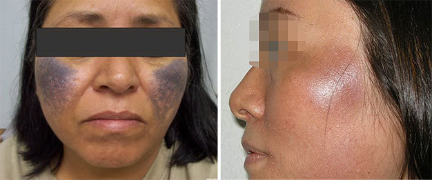 Các trường hợp bị rối loạn sau điều trị nám - Ảnh: Ochronosis Photo