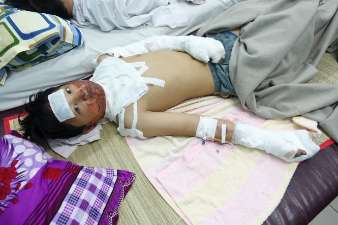 Em Nguyễn Xuân Thành bị mẹ đốt phỏng độ 4 - Ảnh: M.Vinh