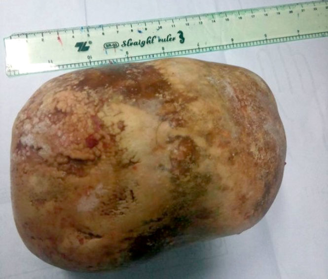 Viên sỏi bàng quang khi được lấy ra - Ảnh: Bệnh viện cung cấp