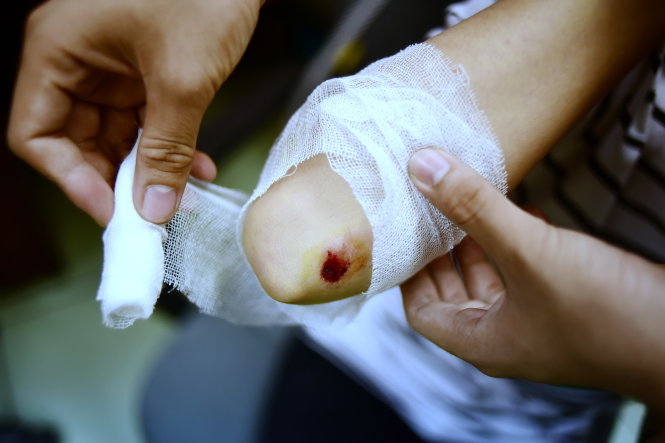 Không nên coi thường những vết thương nhỏ - Ảnh: HỮU THUẬN