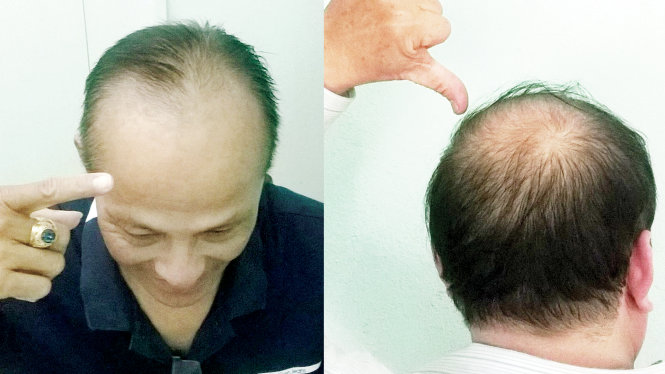 Hói đỉnh và trán: hai dạng hay gặp ở người lớn - Ảnh: TRẦN BÁ THOẠI
