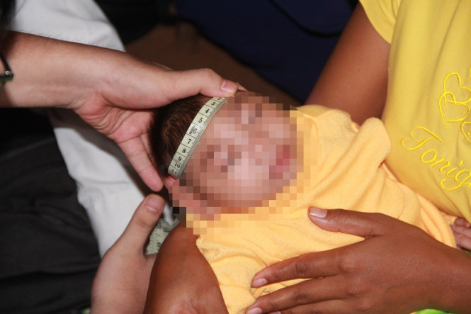 Các chuyên gia thăm khám cho cháu H’Lệ bị di chứng đầu nhỏ nghi do virus zika - Ảnh: THÁI THỊNH