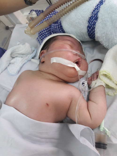 Cháu bé sơ sinh nặng 4,8kg của sản phụ Tâm bị buộc phải sinh thường nên bị gãy xương đòn, xẹp phổi ngay khi mới ra đời – Ảnh: T.V.Thắng
