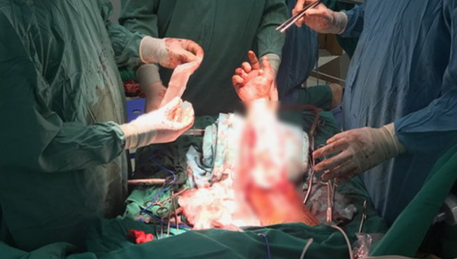 Các bác sĩ tiến hành khâu nối cánh tay đứt lìa