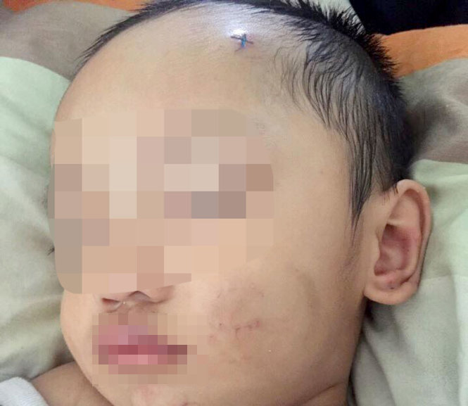 Hình ảnh bé Trường với nhiều vết bầm tím trên cơ thể được cho là bị đánh đập - Nguồn: Facebook