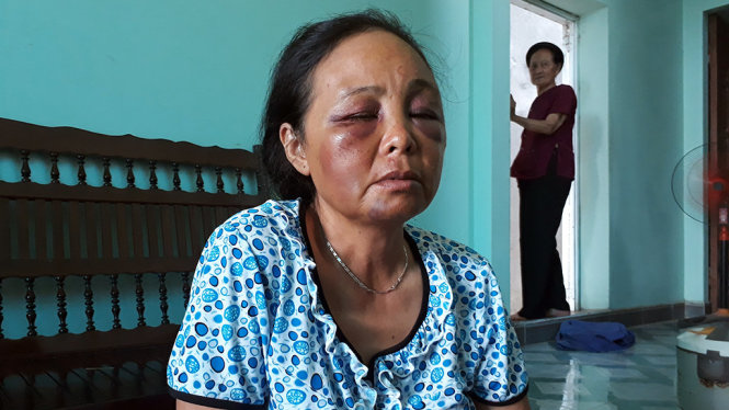 Sau hai ngày xảy ra vụ việc, tinh thần của một phụ nữ bán tăm vẫn còn hoảng loạn, trên mặt nhiều vết bầm tím do bị đánh - Ảnh: Giang Long