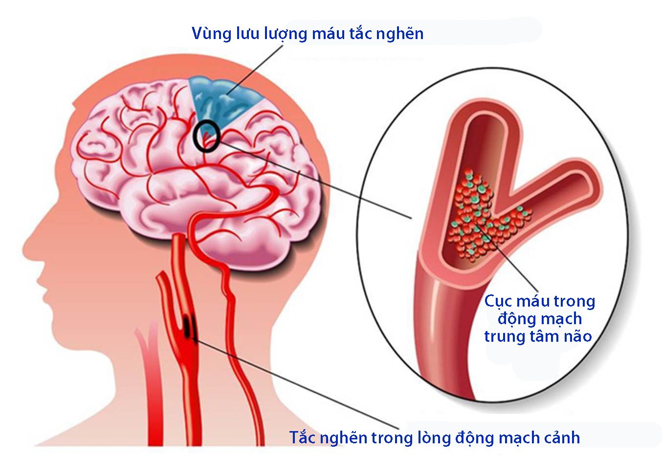 Không nên chủ quan với bệnh tai biến mạch máu não nhẹ - Ảnh 1. Không nên chủ quan với bệnh tai biến mạch máu não nhẹ - Ảnh 1.