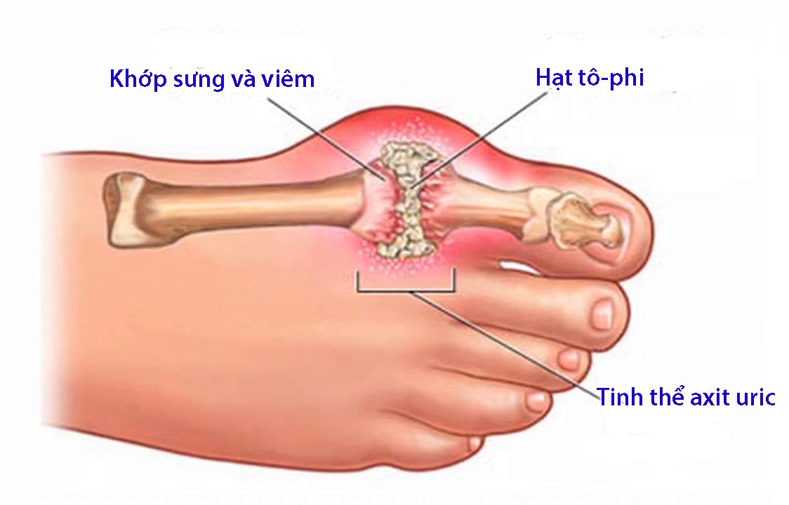 Chẩn đoán và điều trị bệnh gout - Ảnh 1. Chẩn đoán và điều trị bệnh gout - Ảnh 1.