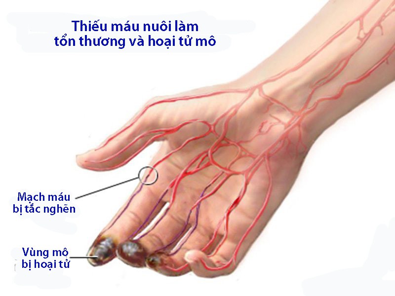 Bệnh Buerger - Ảnh 1. Bệnh Buerger - Ảnh 1.