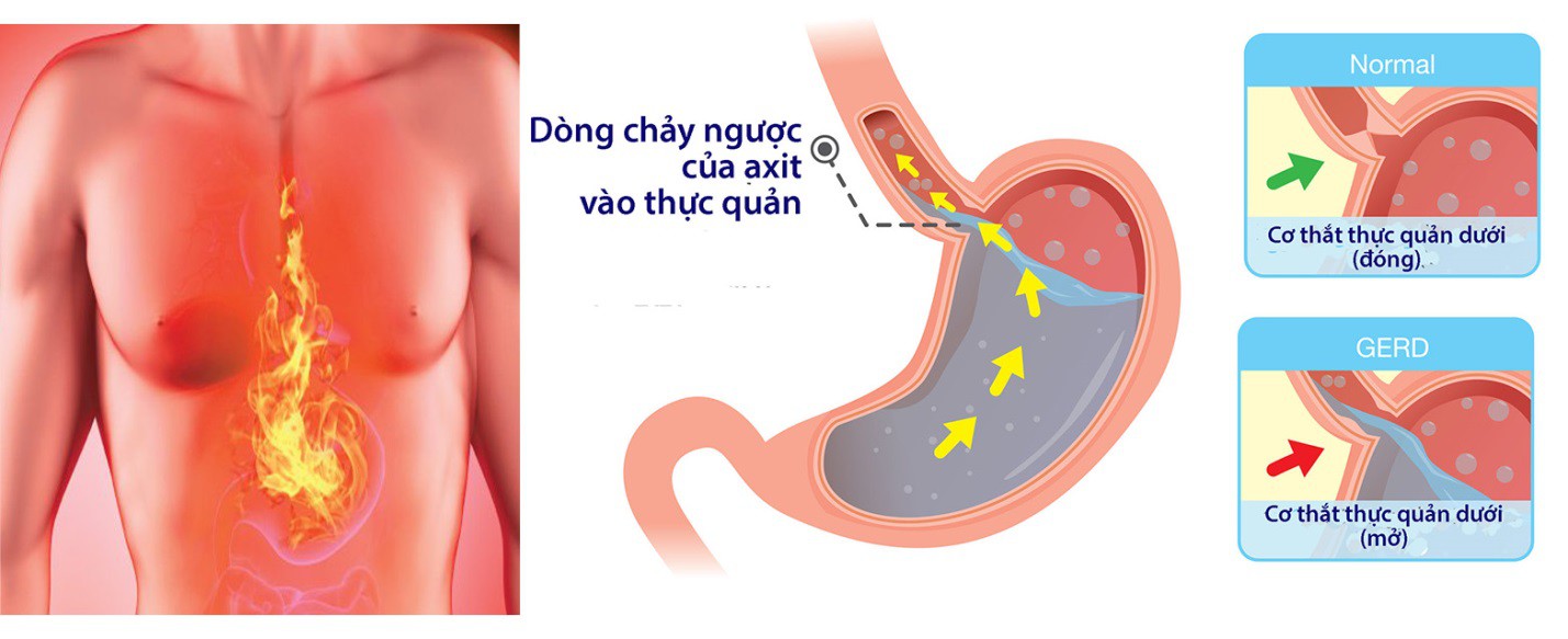 Sự khác biệt giữa chứng ợ nóng và bệnh tim mạch - Ảnh 1.