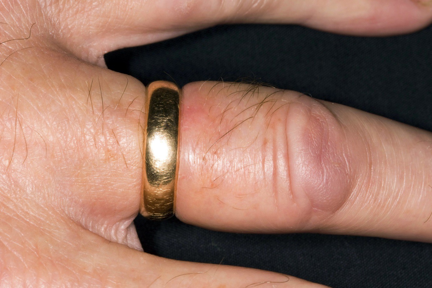 7 nguyên nhân khiến ngón tay sưng phù - Ảnh 1. 7 nguyên nhân khiến ngón tay sưng phù - Ảnh 1.