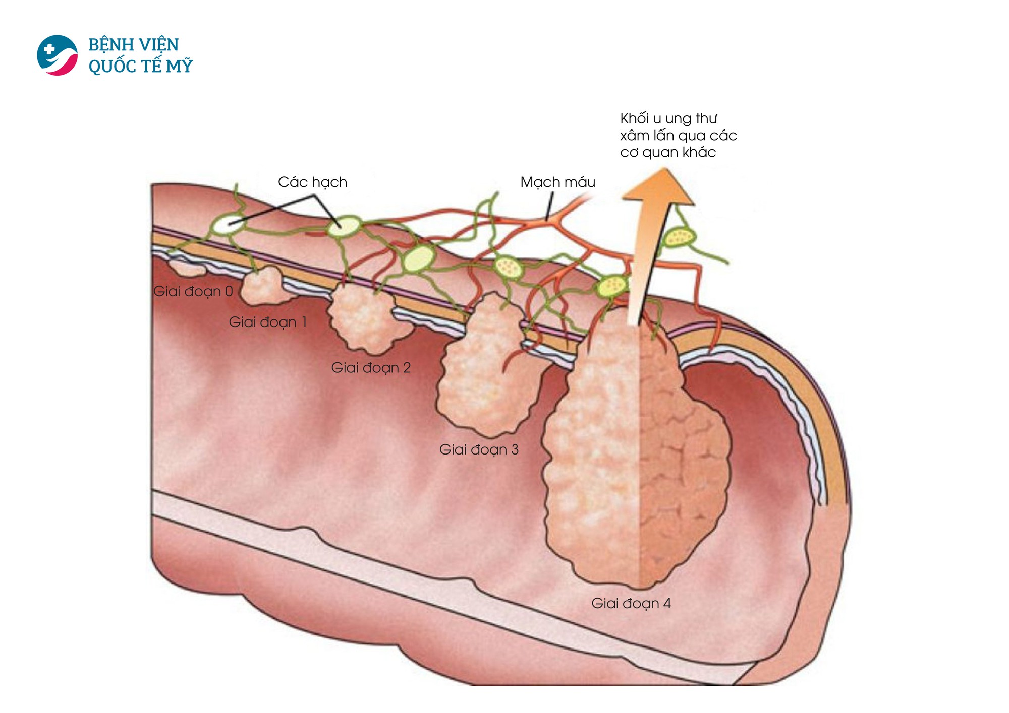 Điều trị và theo dõi ung thư đại trực tràng tránh tái phát - Ảnh 1.