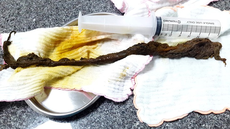 Xơ mít vón cục dài đến 4 tấc trong bụng bệnh nhân - Ảnh 1. Xơ mít vón cục dài đến 4 tấc trong bụng bệnh nhân - Ảnh 1.