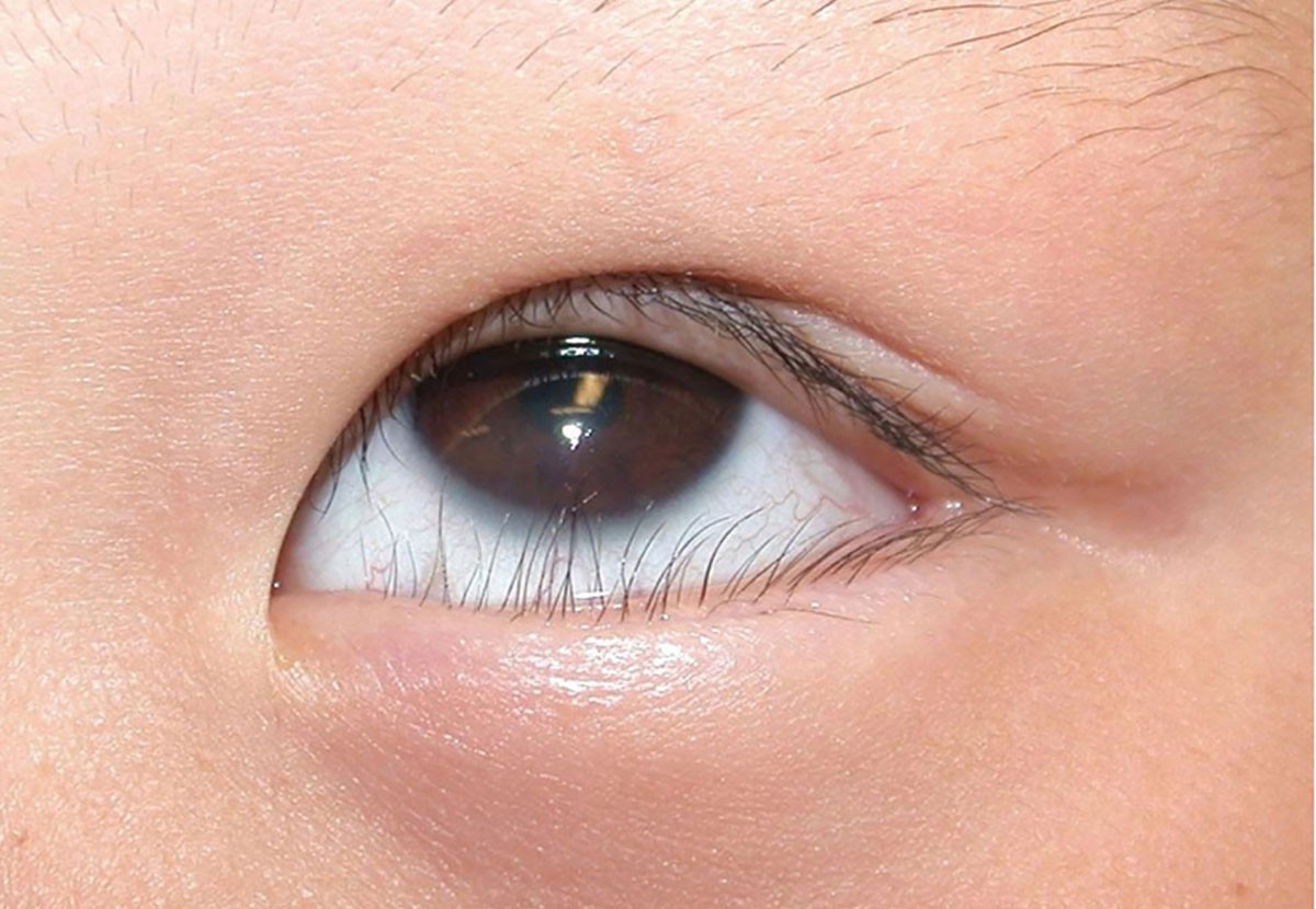 Quặm mi bẩm sinh - Ảnh 1. Quặm mi bẩm sinh - Ảnh 1.