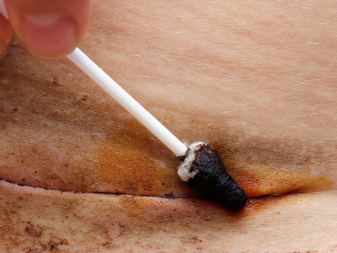 Những dấu hiệu bất thường ở vết mổ đẻ - Ảnh 1. Những dấu hiệu bất thường ở vết mổ đẻ - Ảnh 1.