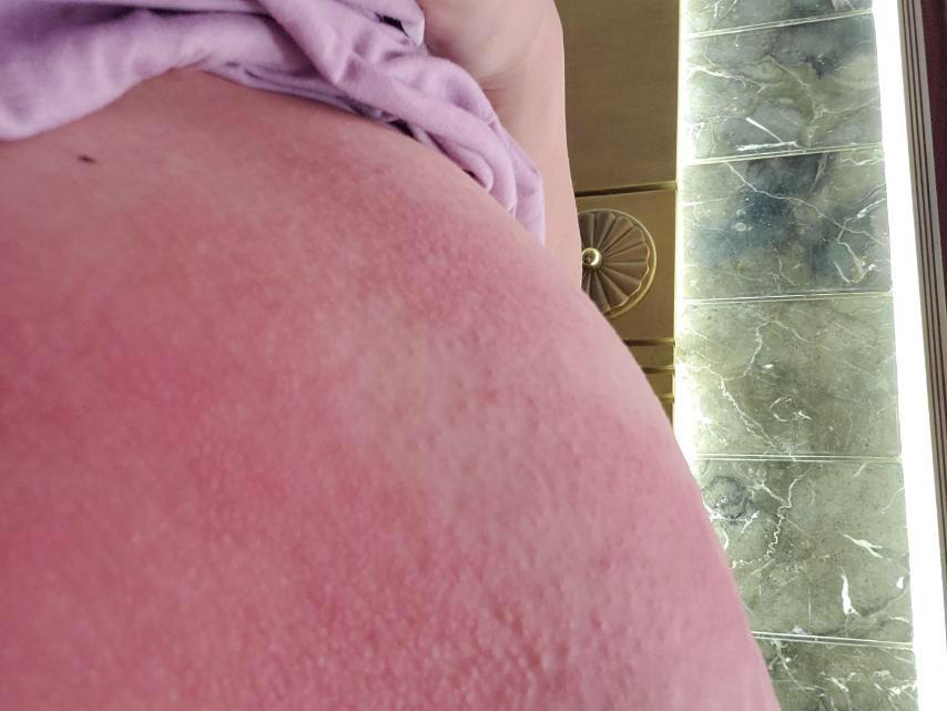 Toàn thân đỏ như tôm luộc, ngứa rát vì thoa rượu gừng nghệ làm đẹp sau sinh - Ảnh 1. Toàn thân đỏ như tôm luộc, ngứa rát vì thoa rượu gừng nghệ làm đẹp sau sinh - Ảnh 1.