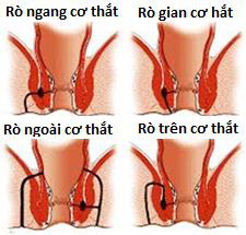 Điều trị rò hậu môn (mạch lươn) bằng phương pháp phẫu thuật - Ảnh 2.