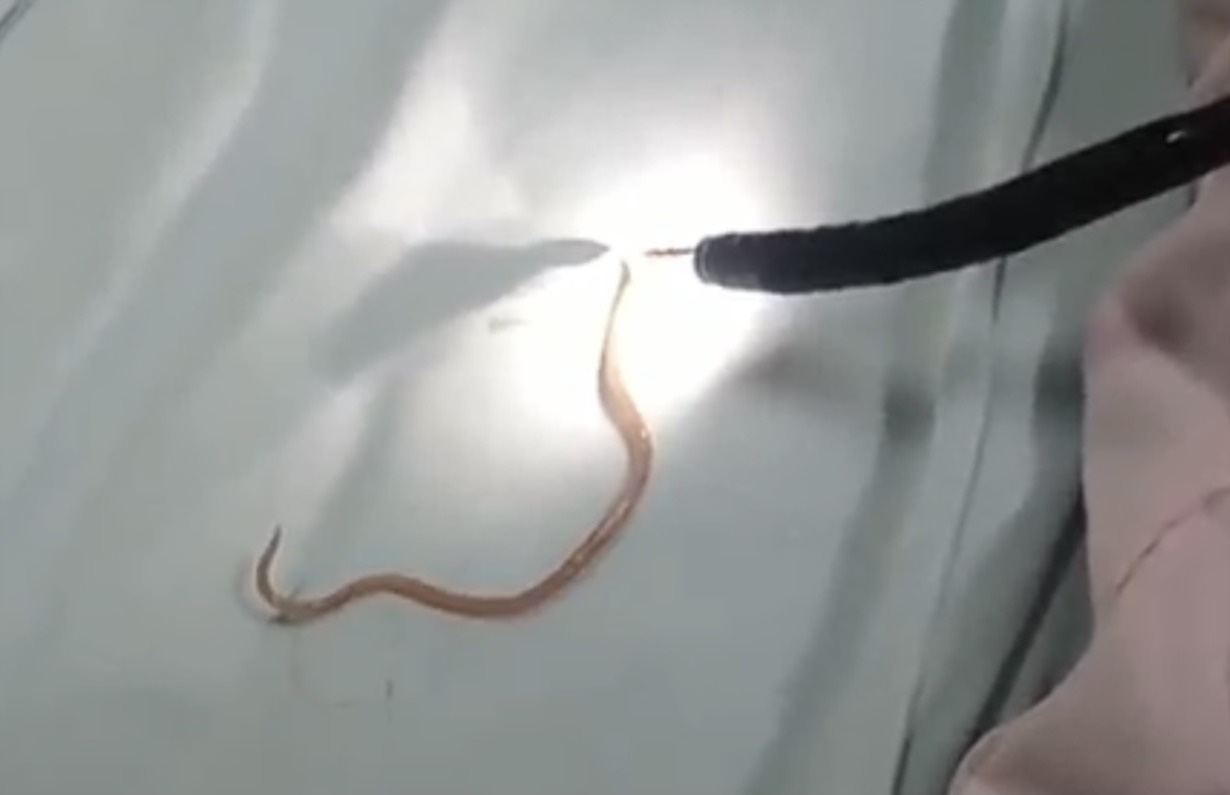 Giun đũa dài 15cm còn sống trong ống tụy của bé trai 5 tuổi - Ảnh 1. Giun đũa dài 15cm còn sống trong ống tụy của bé trai 5 tuổi - Ảnh 1.