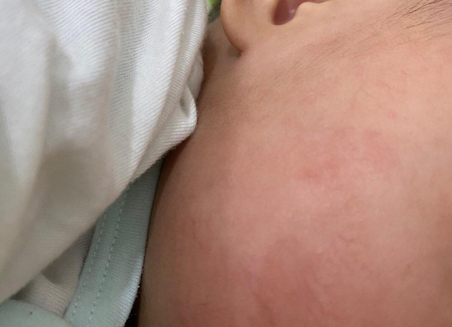 Bé bị ban đỏ trên da có phải là triệu chứng của COVID-19? - Ảnh 1. Bé bị ban đỏ trên da có phải là triệu chứng của COVID-19? - Ảnh 1.