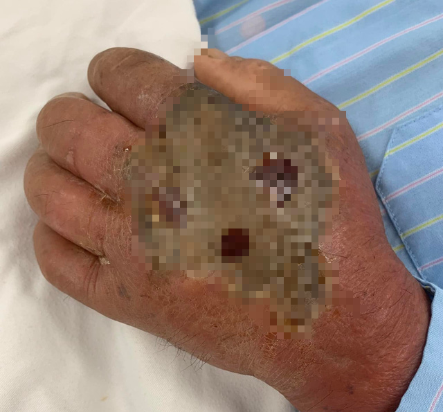 Đắp lá cây chữa rắn cắn, người đàn ông suy đa tạng, hoại tử bàn tay - Ảnh 1. Đắp lá cây chữa rắn cắn, người đàn ông suy đa tạng, hoại tử bàn tay - Ảnh 1.