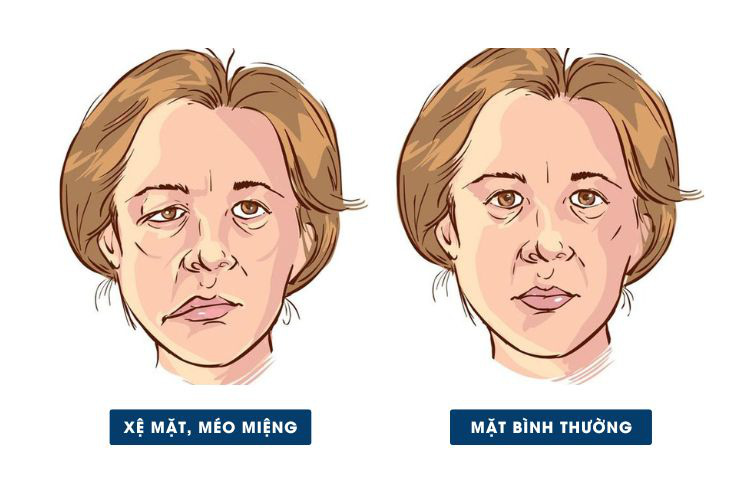 liệt dây thần kinh - Ảnh 1.