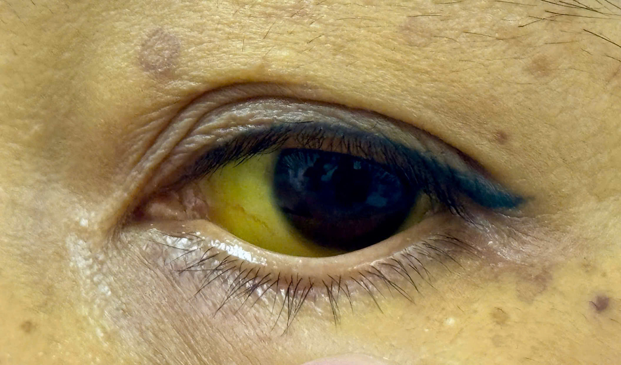 Bỗng vàng da, vàng mắt: Có thể là dấu hiệu cảnh báo gan mật đang gặp vấn đề - Ảnh 1. vàng da - Ảnh 1.