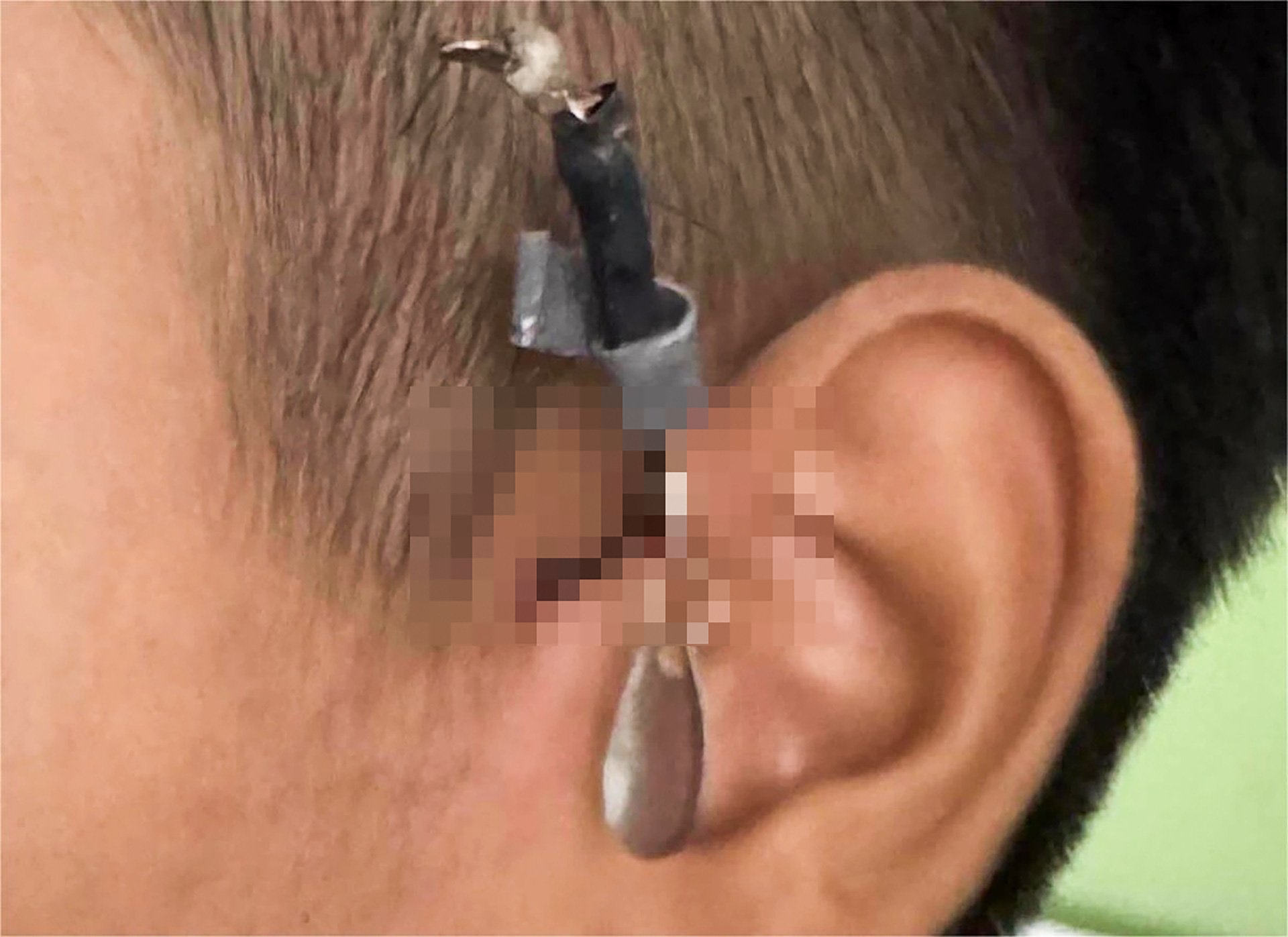 Xem câu cá, bé trai bị móc câu đâm sâu sát vùng tai - Ảnh 1. Xem câu cá, bé trai bị móc câu đâm sâu vào tai - Ảnh 1.
