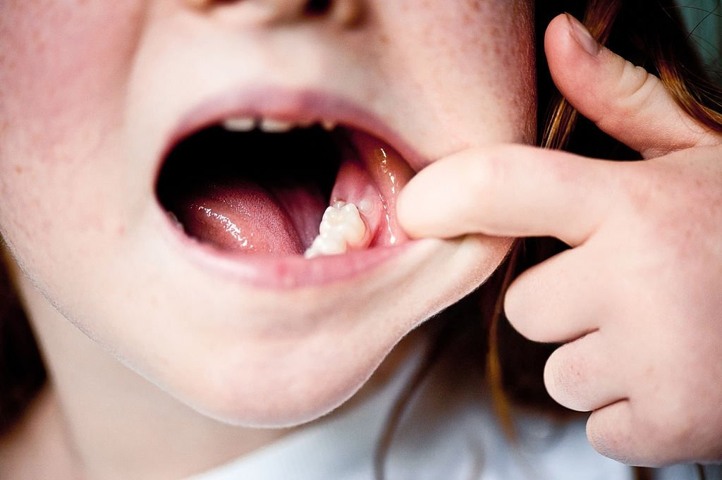 Loạn năng khớp thái dương hàm: Khi đau miệng không phải do sâu răng - Ảnh 2.