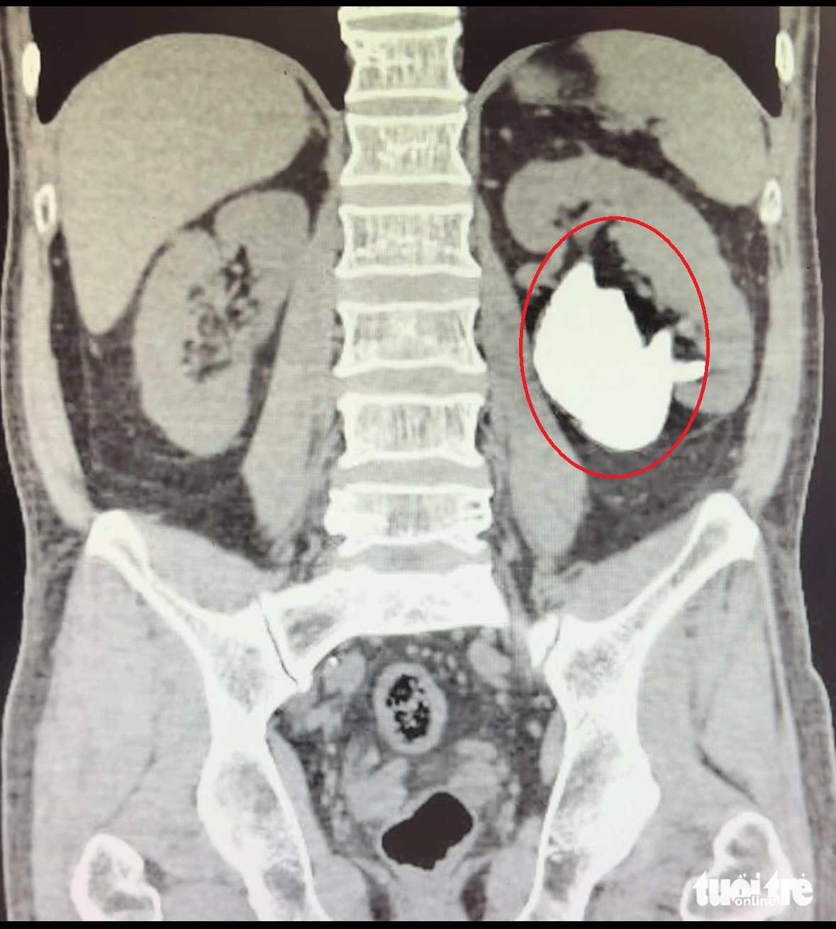 Hình ảnh chụp CT Scan viên sỏi san hô Hình ảnh chụp CT Scan viên sỏi san hô có kích thước