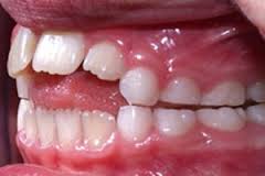 Thói quen mút núm vú giả và những hệ lụy đến răng miệng, ngôn ngữ, tai mũi họng của trẻ - Ảnh 2.