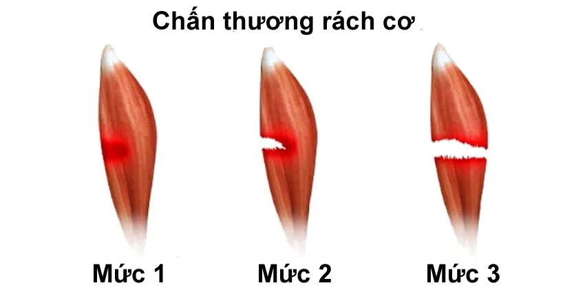 rách cơ đùi - Ảnh 2.