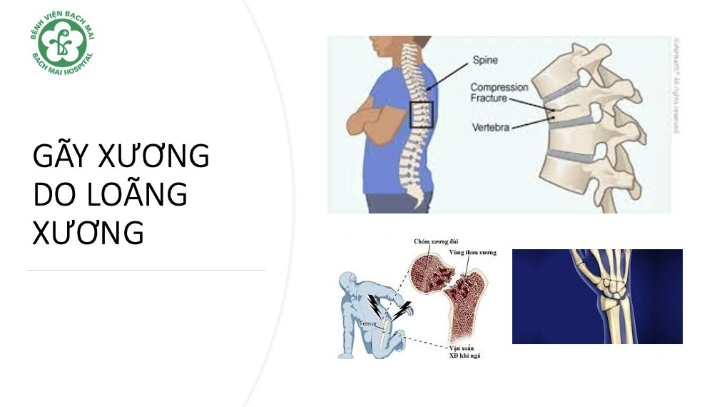 Loãng xương - căn bệnh bị xem nhẹ nhưng tỉ lệ tử vong cao như ung thư và đột quỵ - Ảnh 1. loãng xương - Ảnh 1.