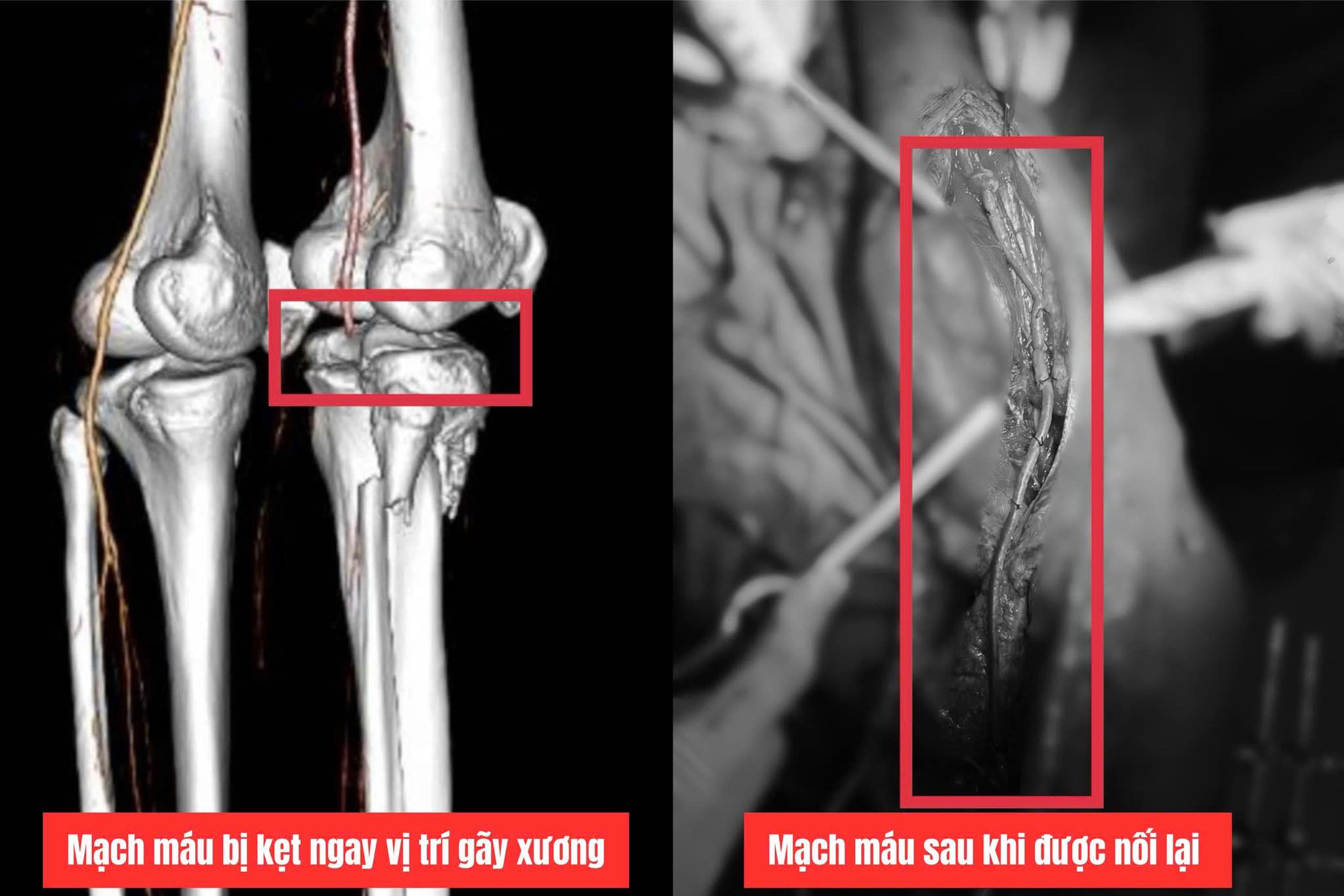 Lấy 40cm tĩnh mạch cứu chân cho chàng trai 17 tuổi - Ảnh 2.