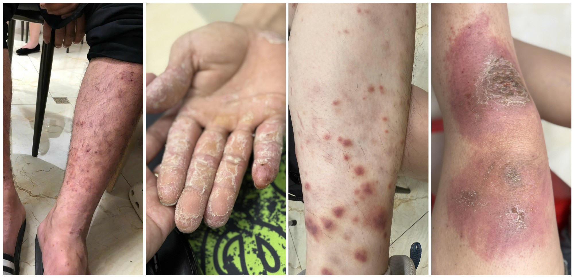 ៥ ជំងឺស្បែកទូទៅក្រោយរដូវវស្សា និងវិធីព្យាបាល - រូបថត ២. 5 bệnh da liễu thường gặp trong mùa mưa lũ và cách xử lý - Ảnh 2.