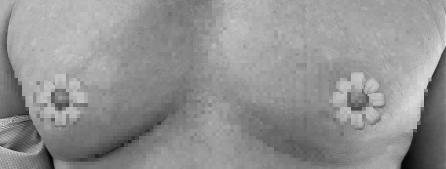 ung thư vú - Ảnh 1.