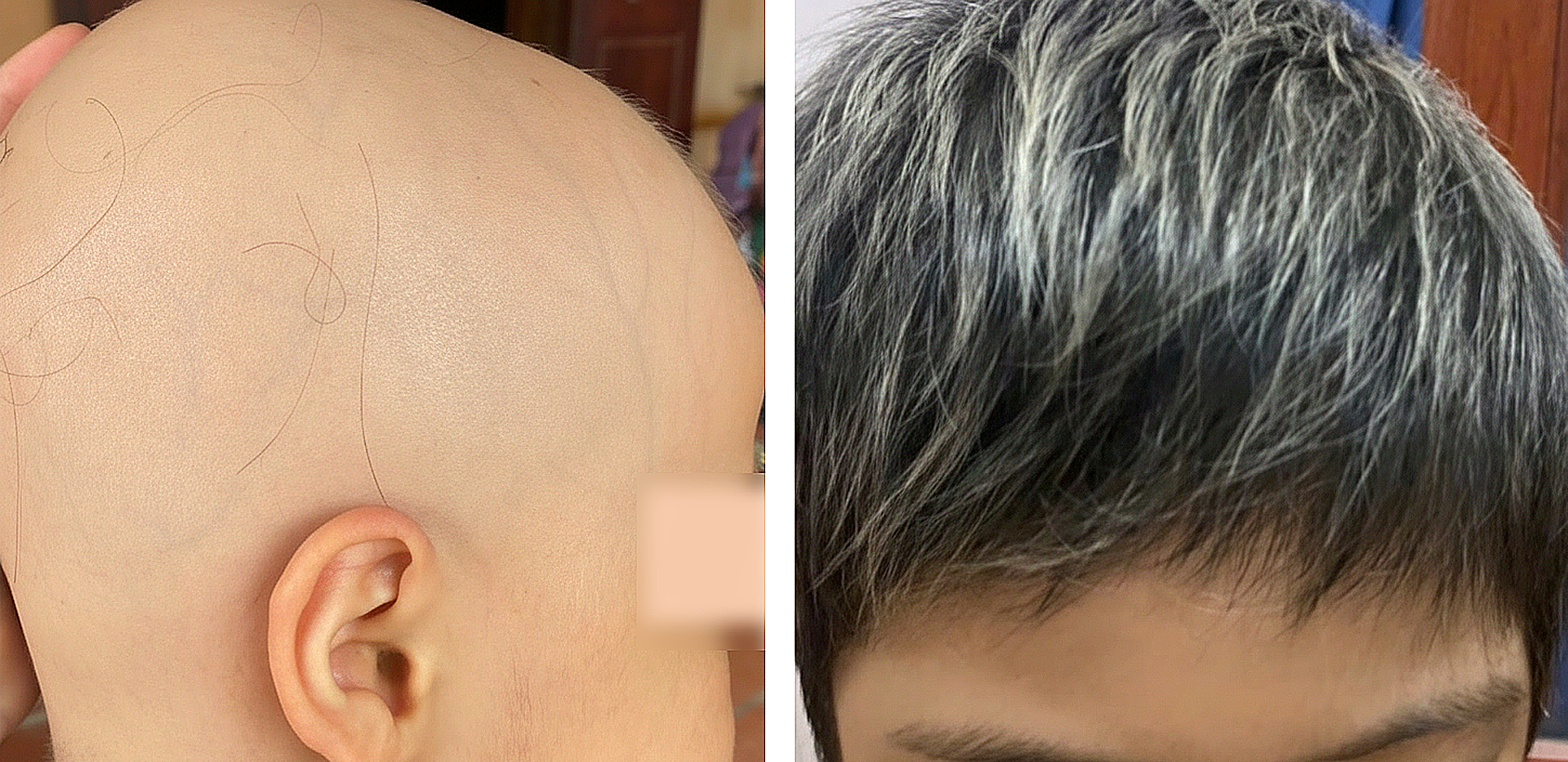 Bé gái 7 tuổi bị rụng hết tóc được điều trị thành công - Ảnh 1.