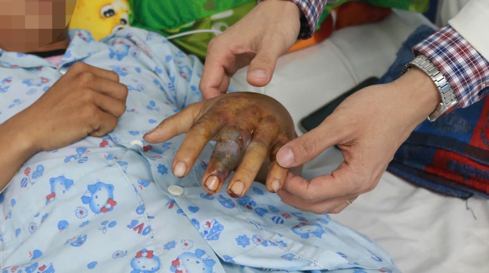 Tự đắp lá chữa rắn cắn, nam thanh niên bị nhiễm độc nặng - Ảnh 1.