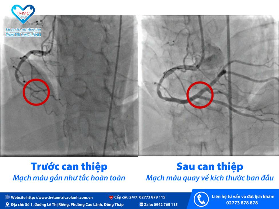 Bệnh viện Tâm Trí Cao Lãnh cứu sống 5 ca nhồi máu cơ tim cấp - Ảnh 1.