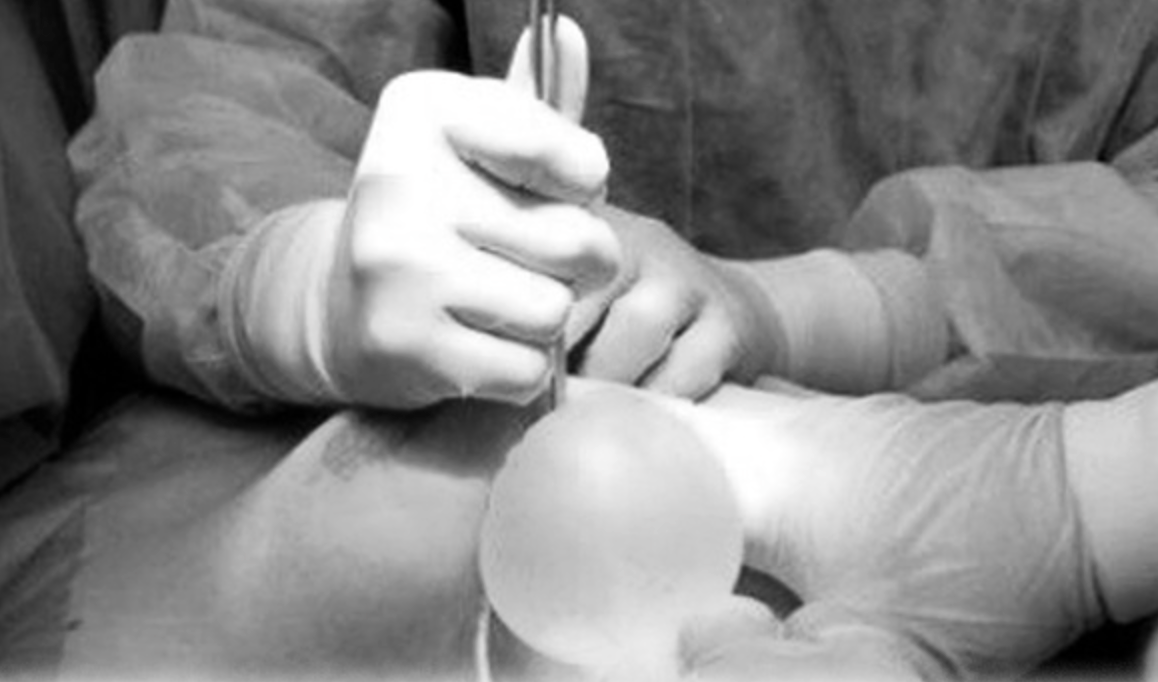 nâng ngực - Ảnh 1.