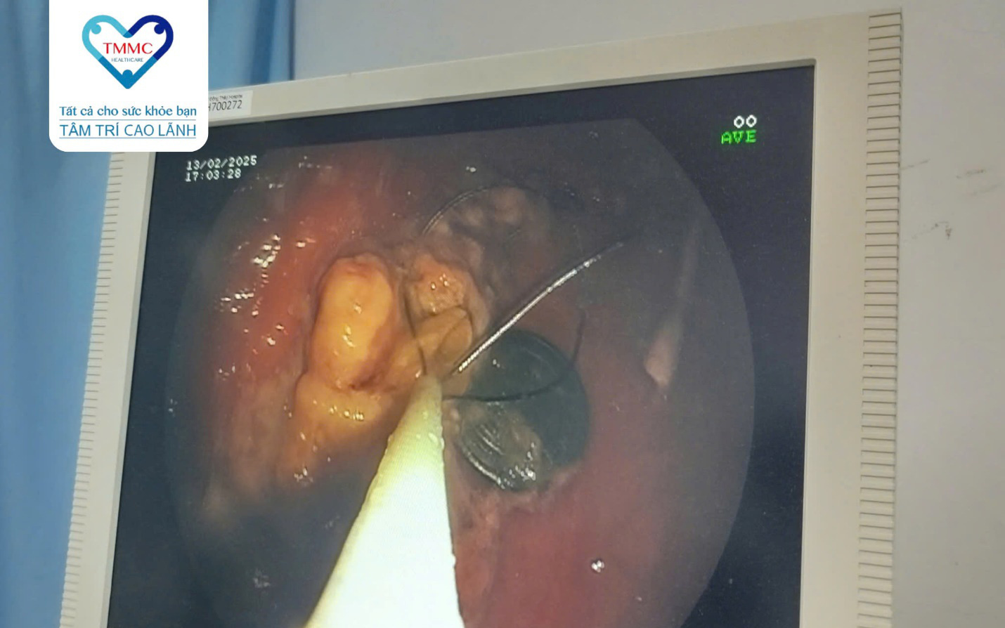 Xem điện thoại trong khi ăn, bé gái 13 tuổi suýt nguy kịch - Ảnh 1.