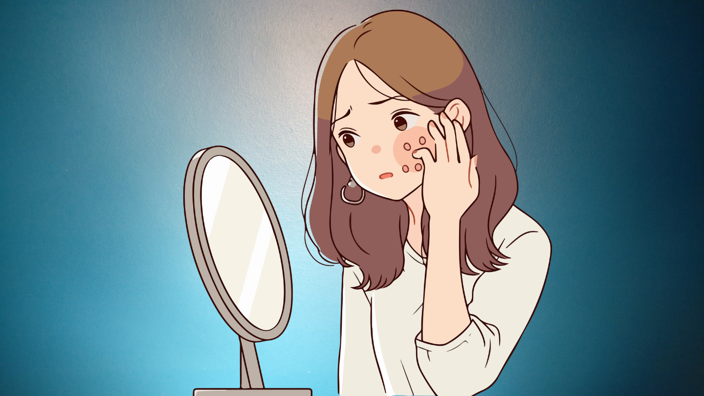 Vì sao bạn không nên tự ý nặn mụn?- Ảnh 1.